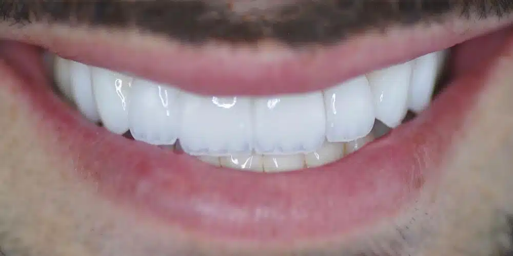 Real SAIZ aesthetic restorative dentistry result